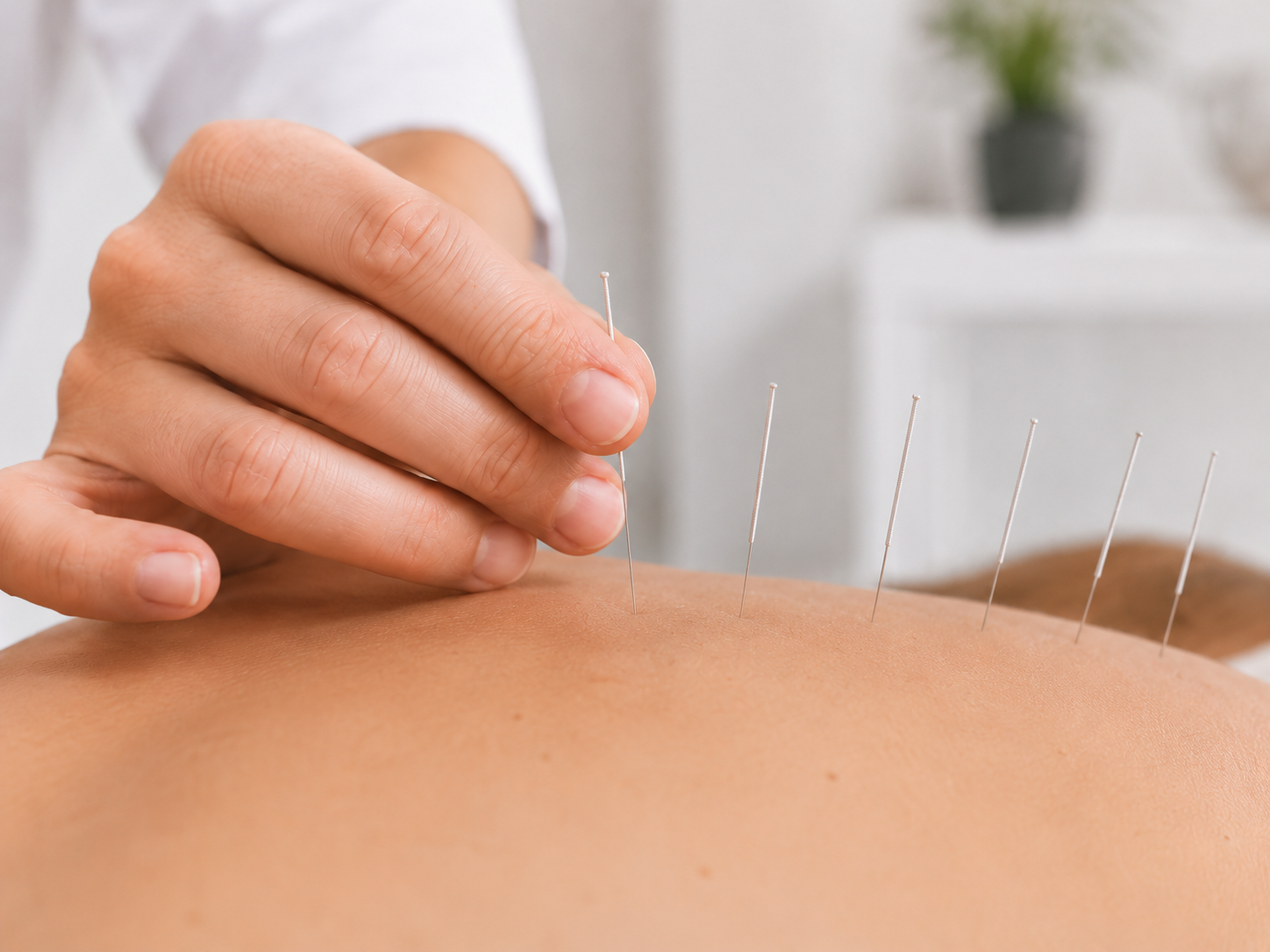 Acupuntura - imagen 1