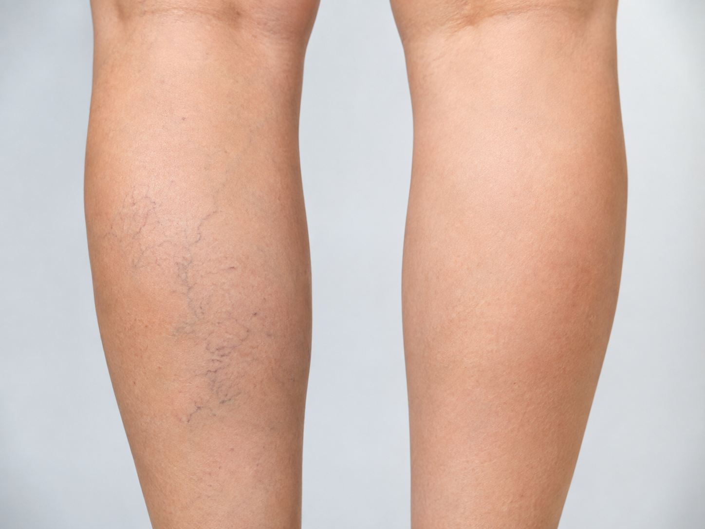 Escleroterapia - imagen 3