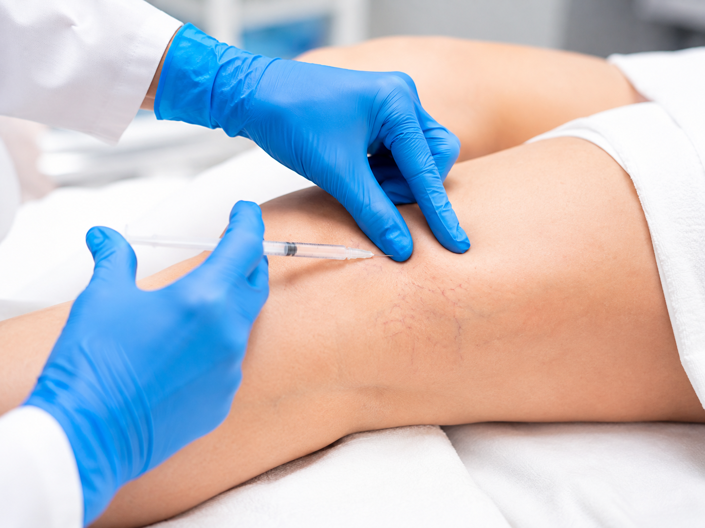 Escleroterapia - imagen 2